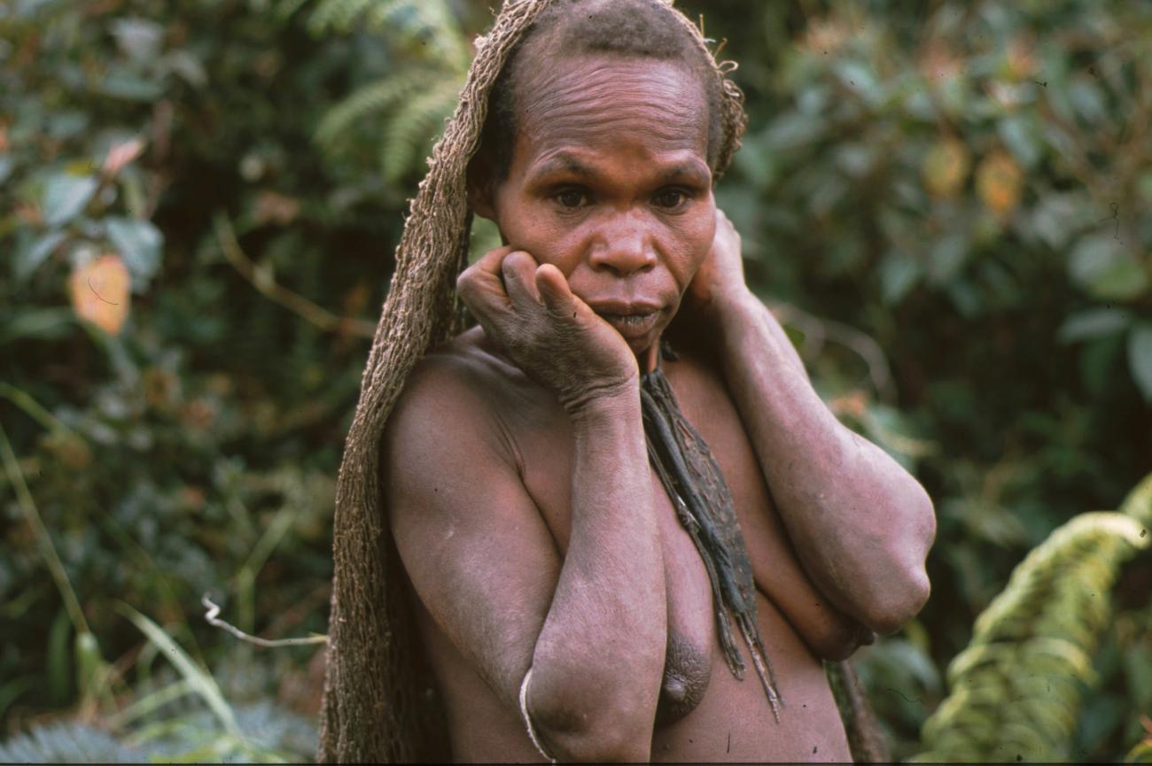 BD/166/95 -
Portrait of woman with missing phalanges